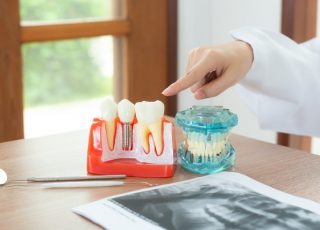Implants dentaires : ce qu’il faut savoir